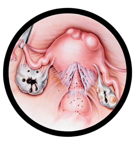 Endometriosis min