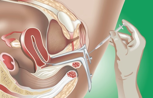 Inseminacion Intrauterina Barranquilla min